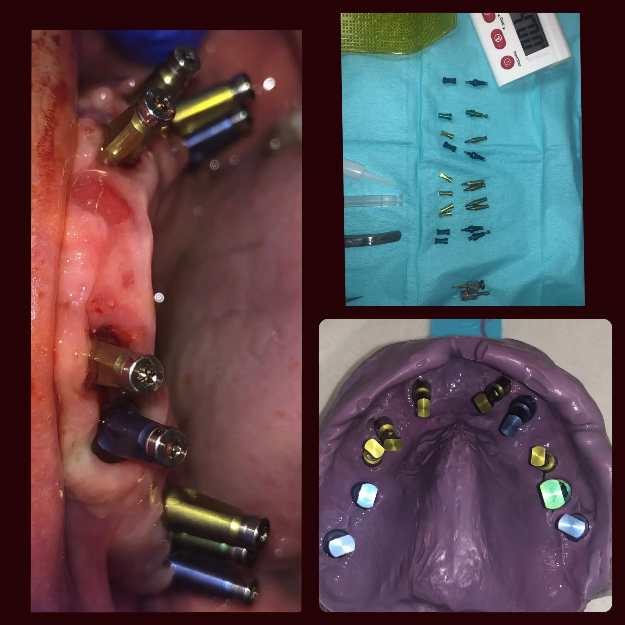 All on X implants