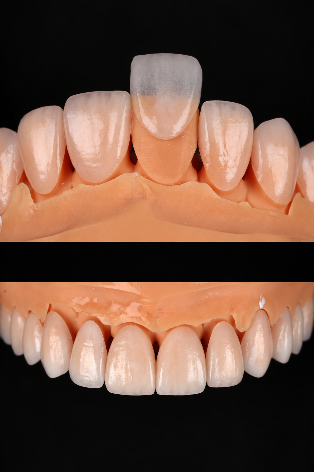 Custom porcelain veneer on a tooth model