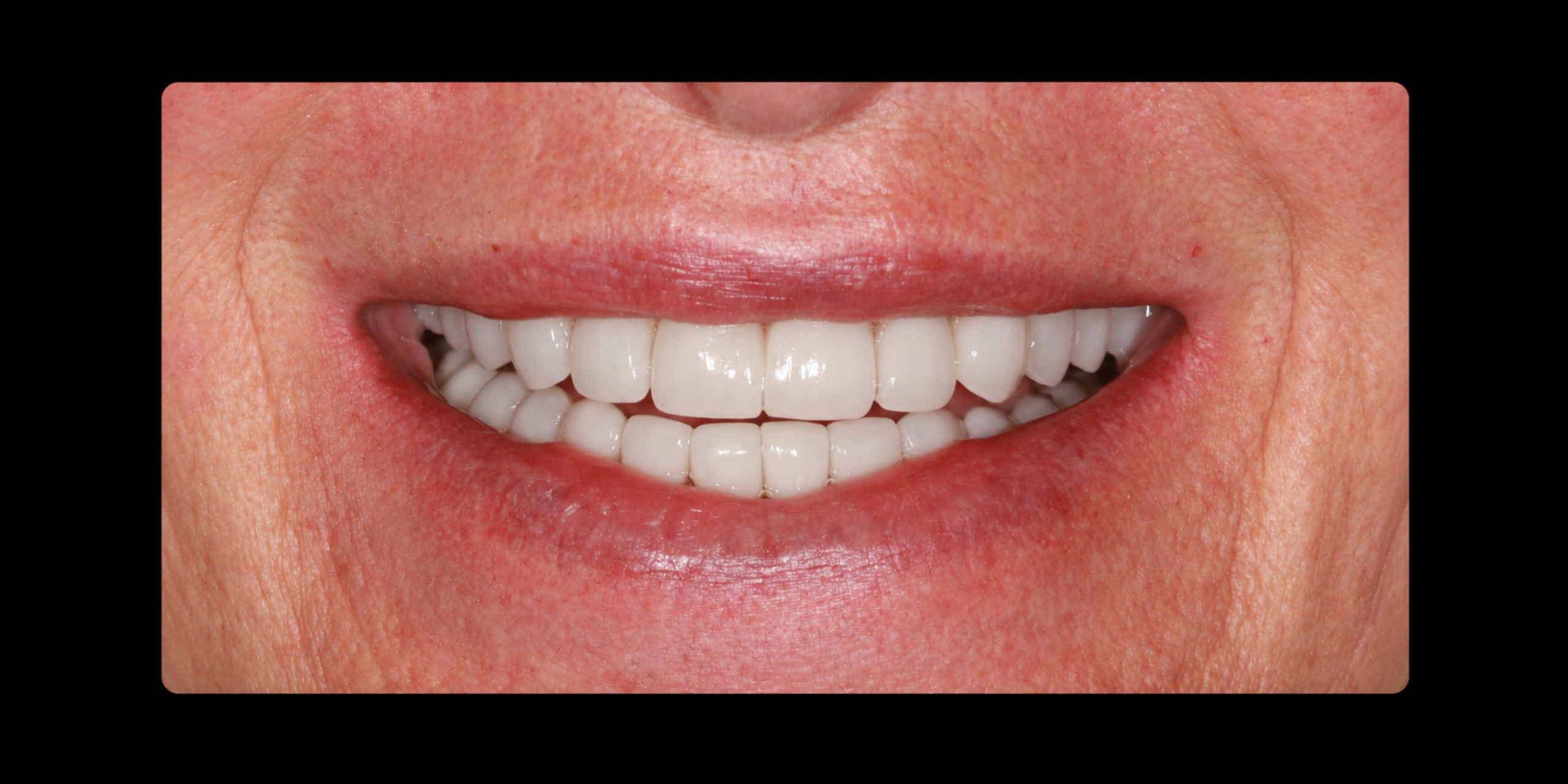 Smile after full-mouth reconstruction with porcelain veneers and crowns at NYC Dental Studio
