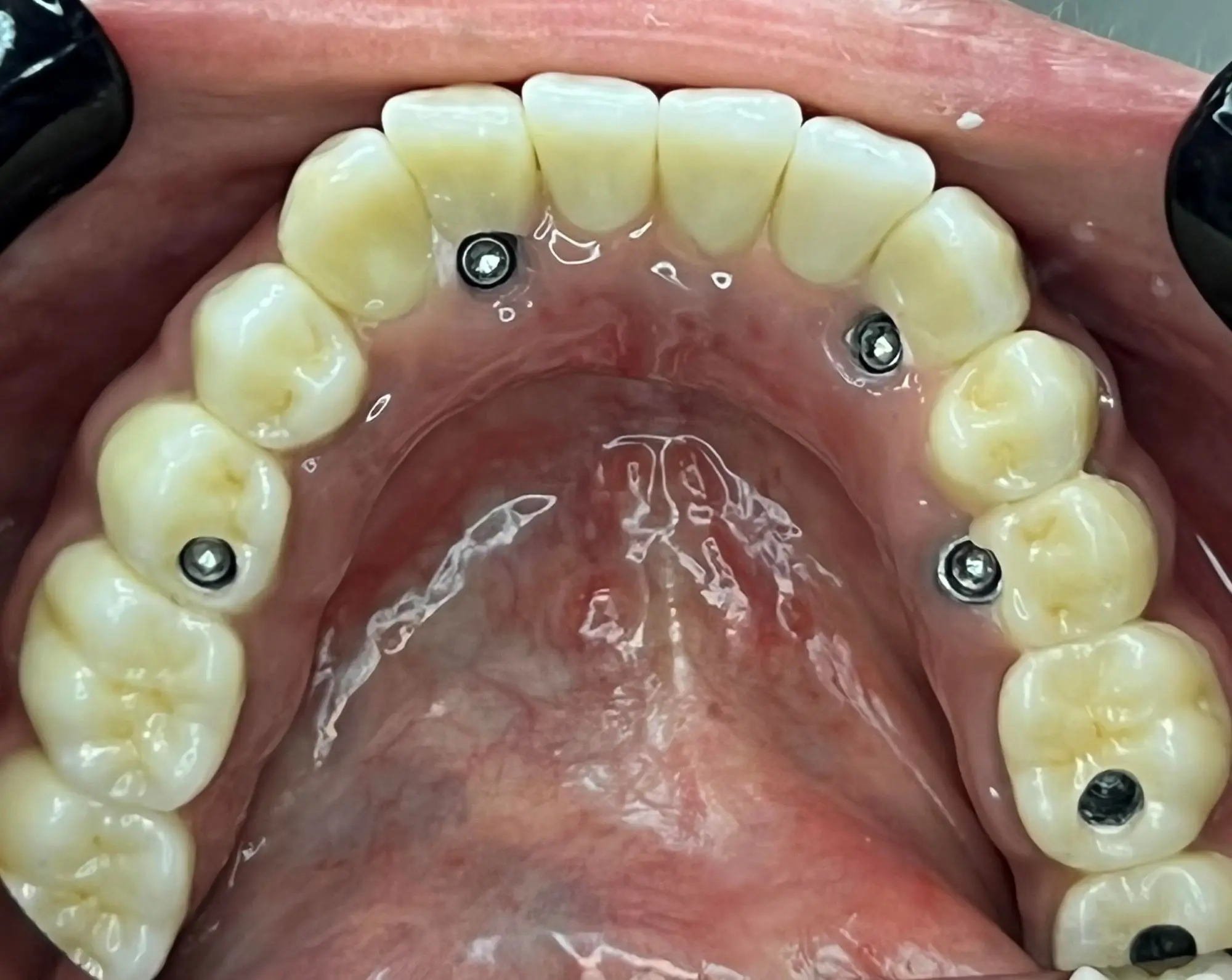 implant