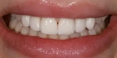 Smile after six porcelain veneers at NYC Dental Studio
